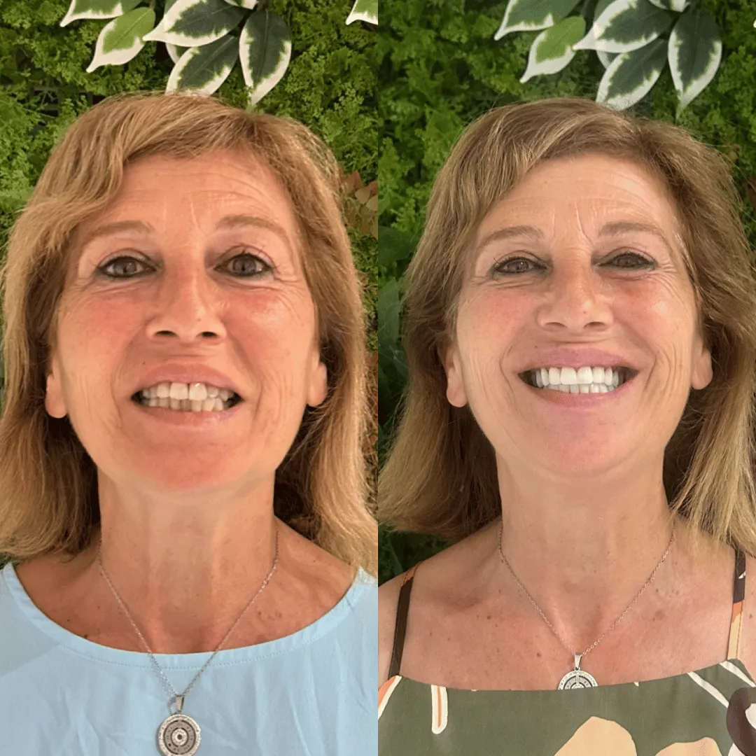 Paziente NobiDent, confronto visivo del sorriso