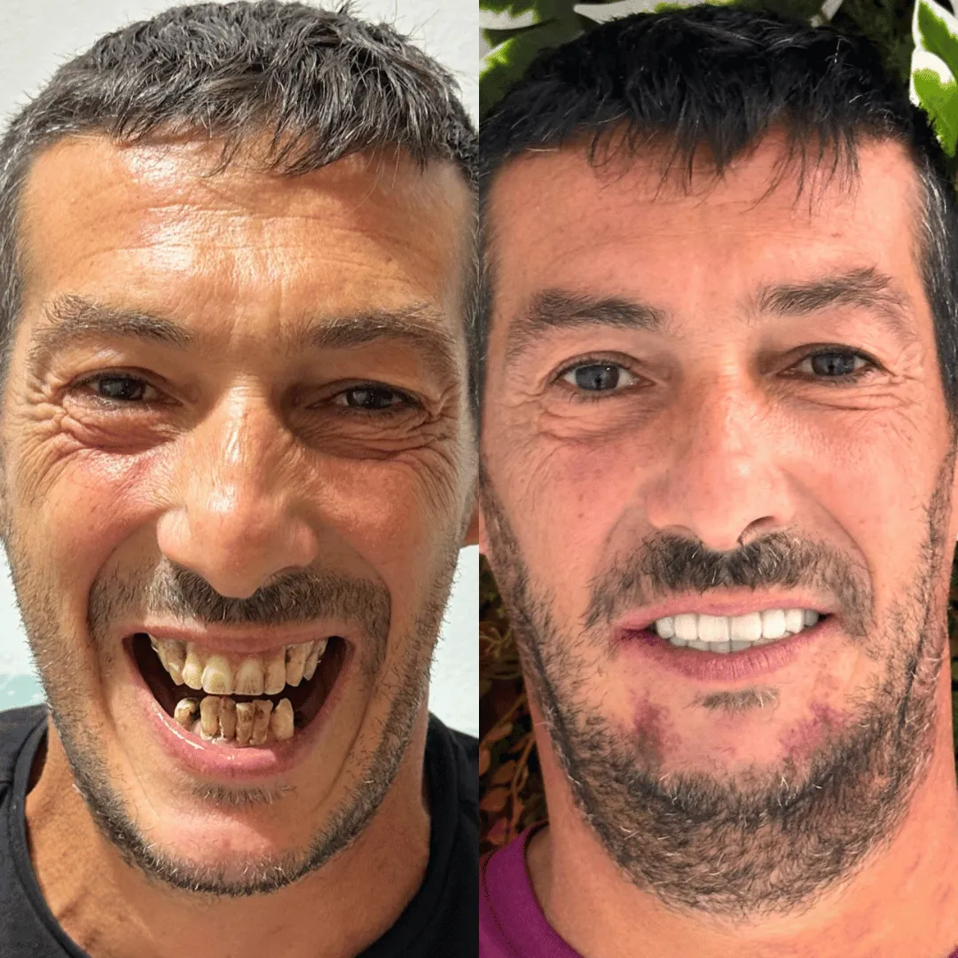 Paziente NobiDent, prima e dopo una riabilitazione dentale