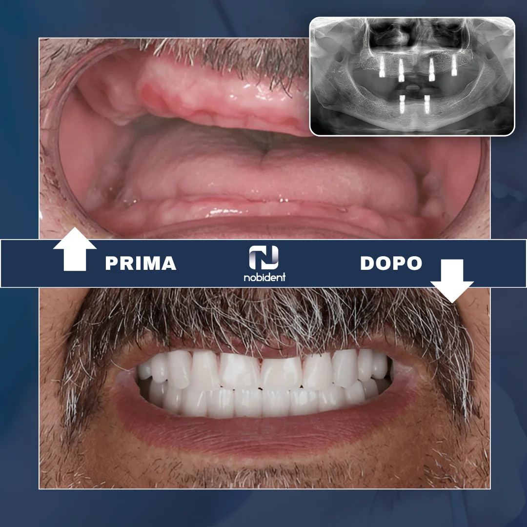 Paziente NobiDent, riabilitazione dentale con radiografia