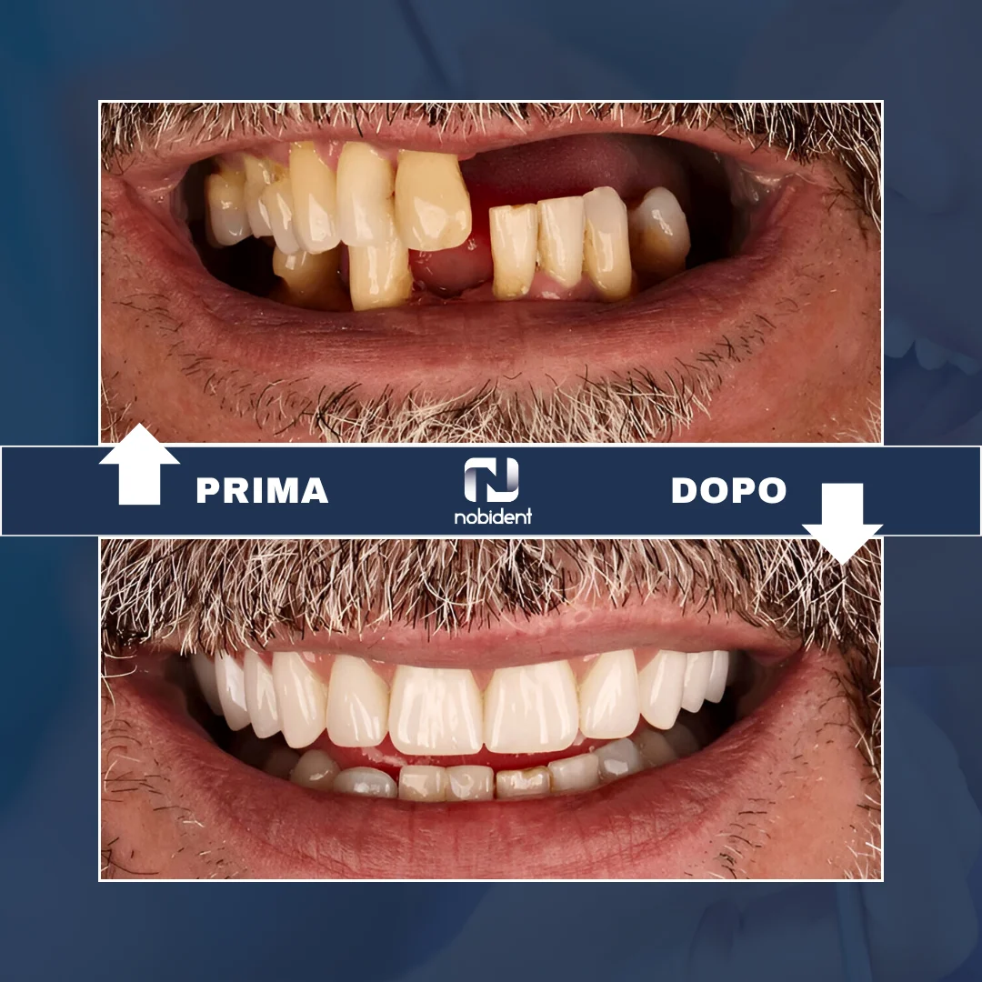 Caso NobiDent, prima e dopo del sorriso