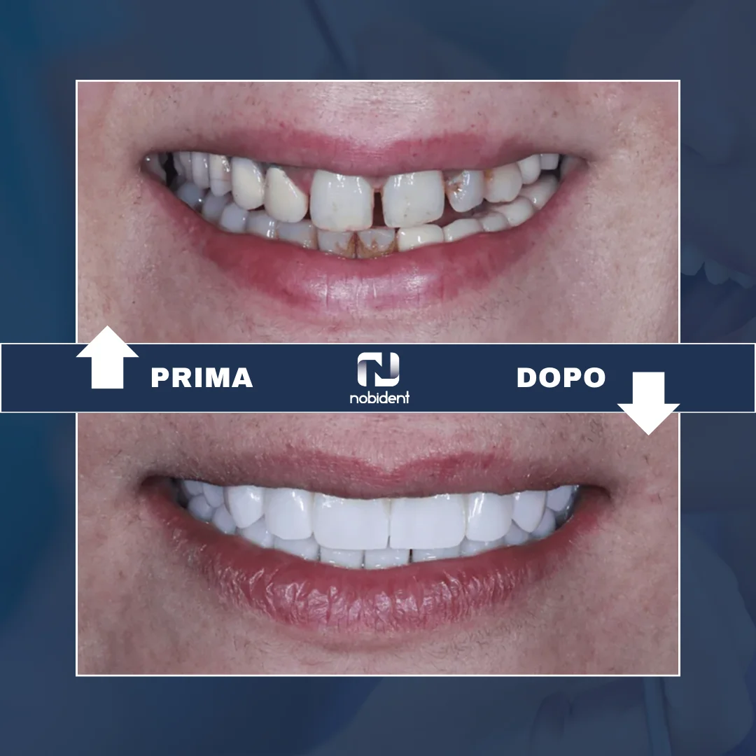 Paziente NobiDent, confronto del sorriso prima e dopo